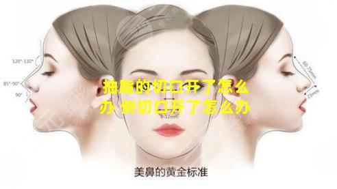 抽脂的切口开了怎么办 侧切口开了怎么办